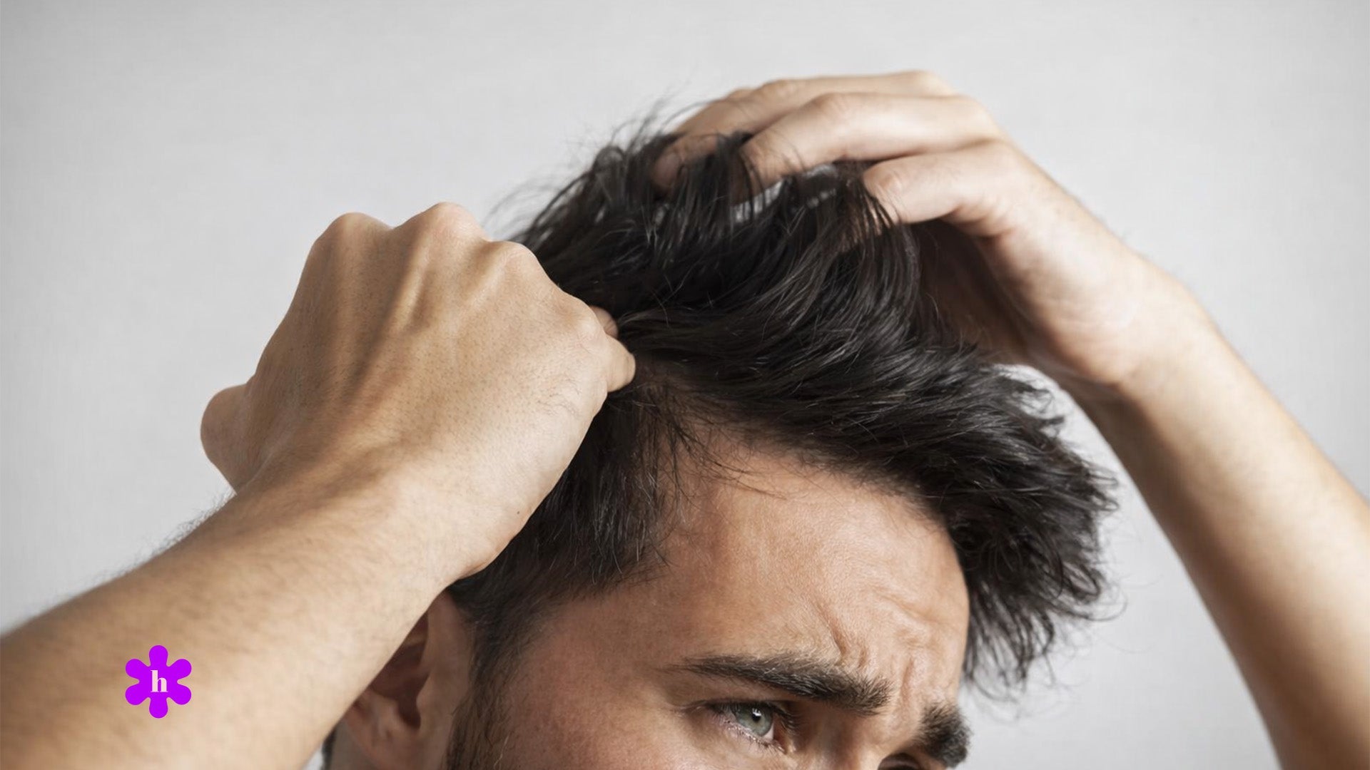 Alles over haaruitval bij mannen