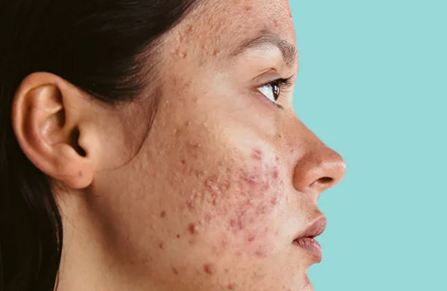 Drs Leenarts Oily/Acne Skincare Routine Set - 3x50+100ml