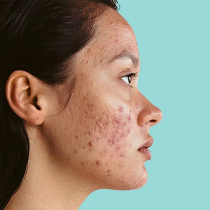 Drs Leenarts Oily/Acne Skincare Routine Set - 3x50+100ml